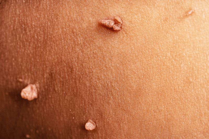 how to shrink hemorrhoid skin tag