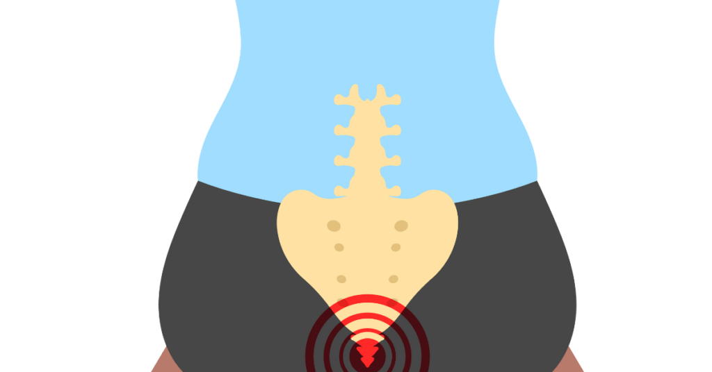 Illustration of pilonidal cysts near the tailbone, highlighting Pilonidal Cysts and Hygiene